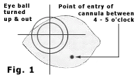 Fig. 1 — Eye turned up-and-out; point of entry of the cannula in the infra-nasal quadrant between the 4 and 5 o’clock positions.