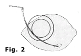 Fig. 2 — The cannula’s curvature conforms to the curvature of the eyeball; the tip is placed in the opening through Tenon’s fascia.