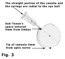 Fig. 3 — Side view of the cannula fully inserted: straight portion and syringe radial to the eyeball, sub-Tenon’s space entered 5 mm from the limbus, tip 5 mm from the optic nerve.